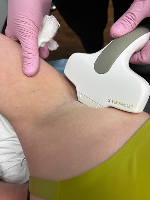 Prowave LX Laser Hair Removal Treatment Evergreen CO